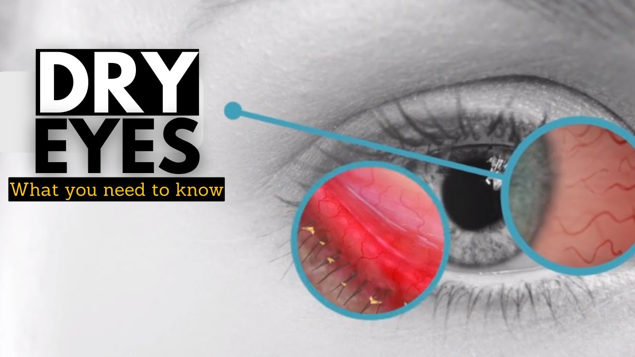 Dry Eye Syndrome, Causes, Signs and Symptoms, Diagnosis and Treatment.