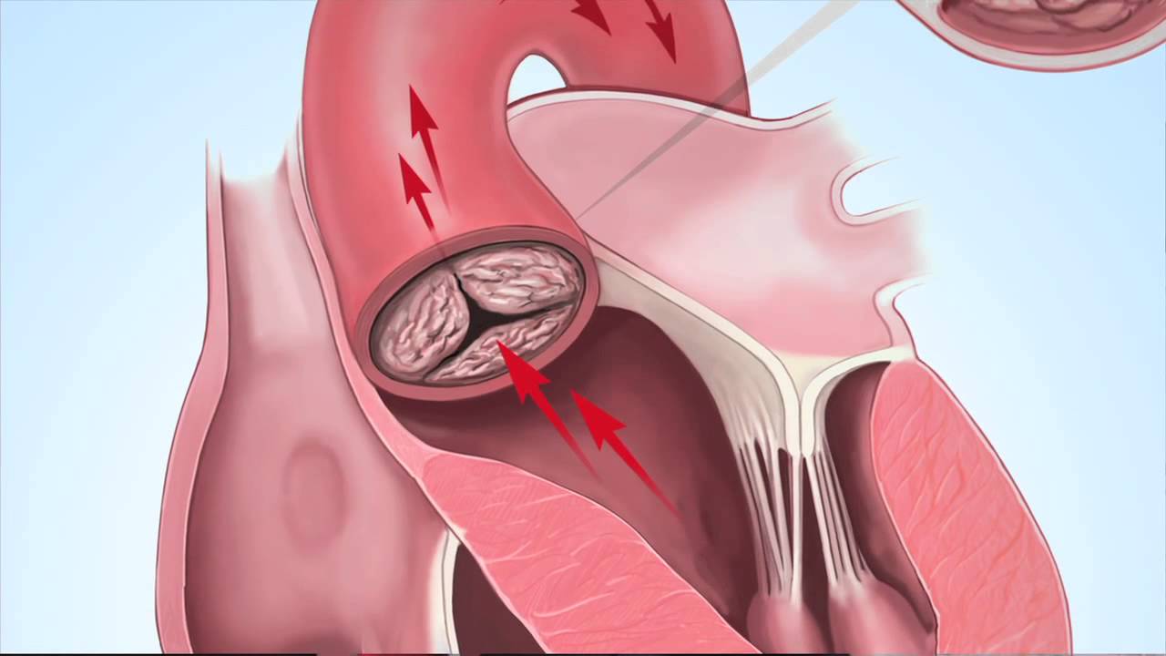 Understanding Aortic Stenosis with Dr. Marc Gillinov