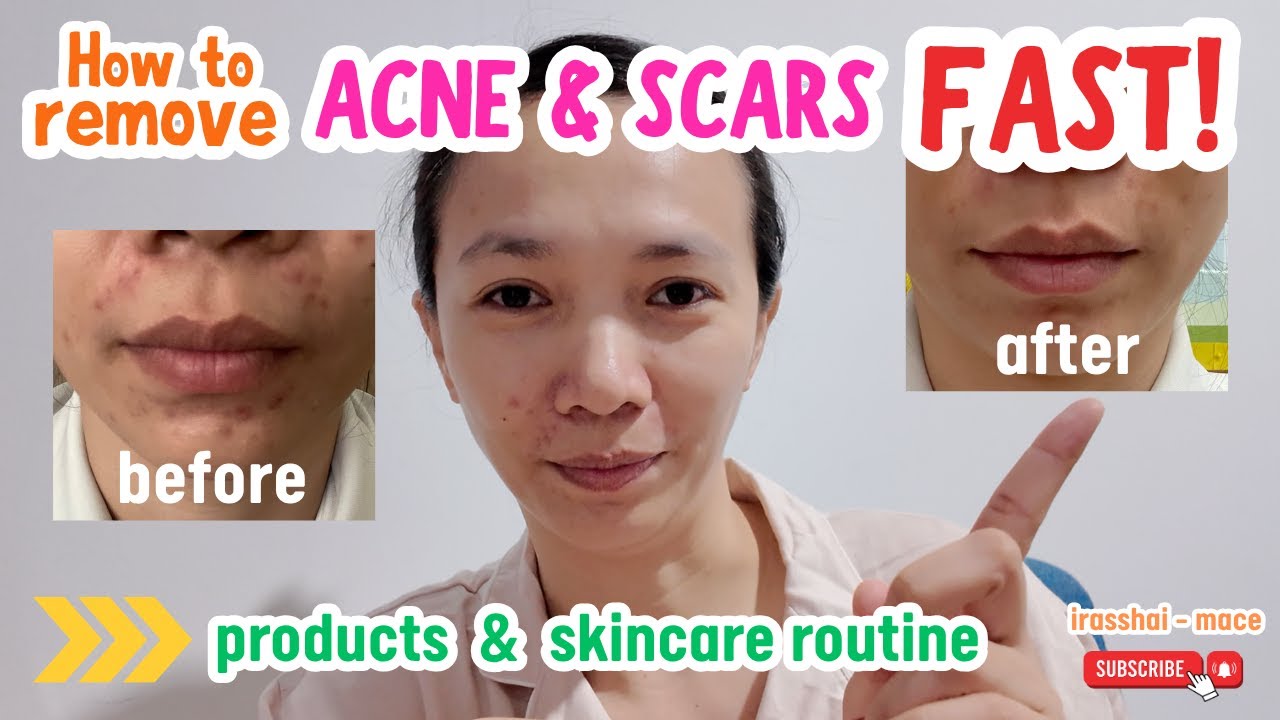 How to get rid of pimples and acne marks FAST | Paano mabilis mawala ang pimples | irasshai-mace