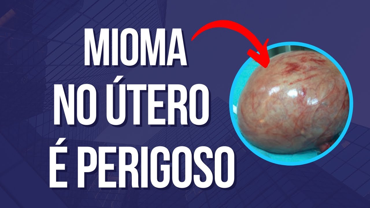 MIOMA no útero é PERIGOSO?