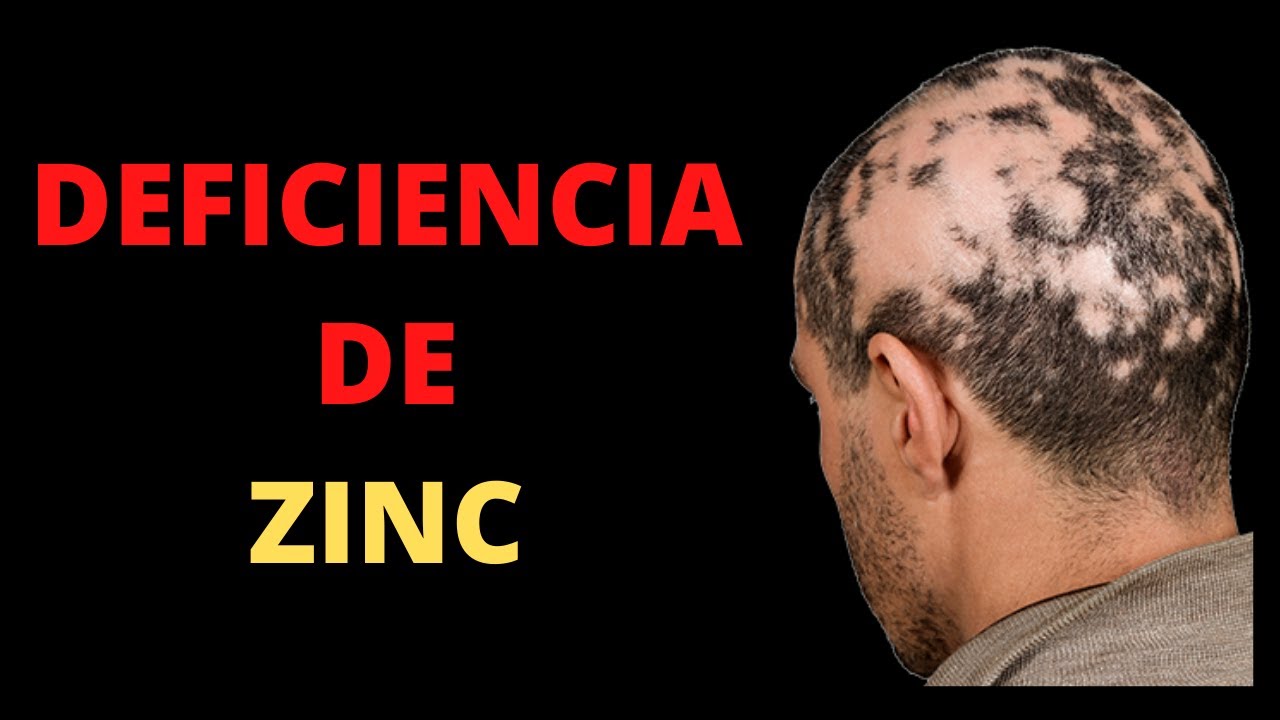 8 Datos de DEFICIENCIA DE ZINC que nunca debes de ignorar (Zinc bajo)