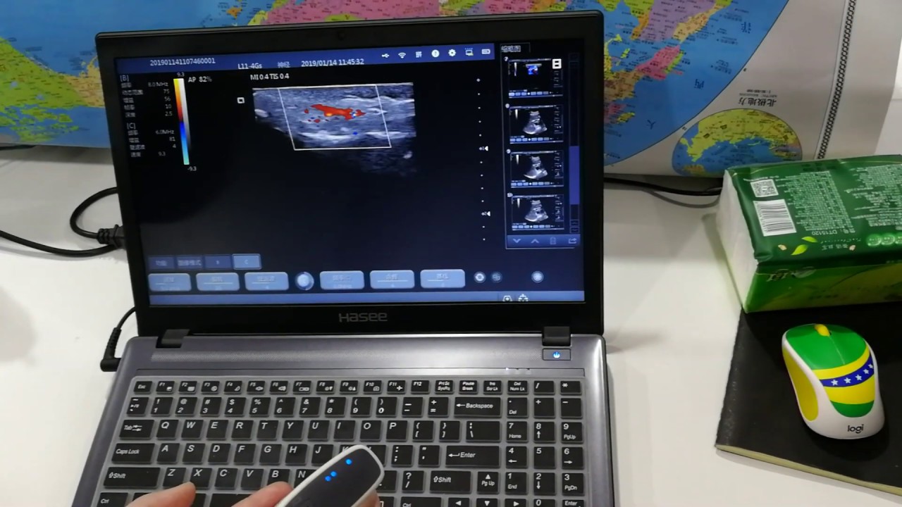 Finger Vessel Youkey D8 wireless Color doppler pocket ultrasound system with linear transducer