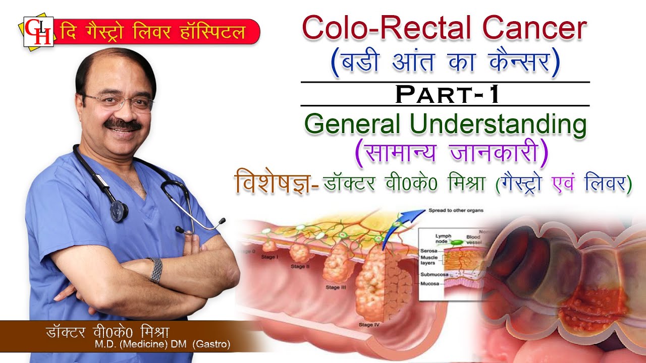 Colorectal Cancer (बड़ी आंत का कैंसर ) Part-1 (सामान्य जानकारी )