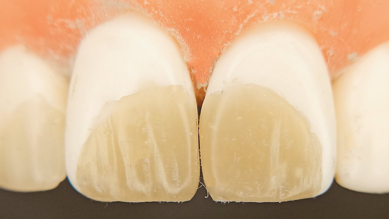 Class IV both upper 1 composite filling restoration