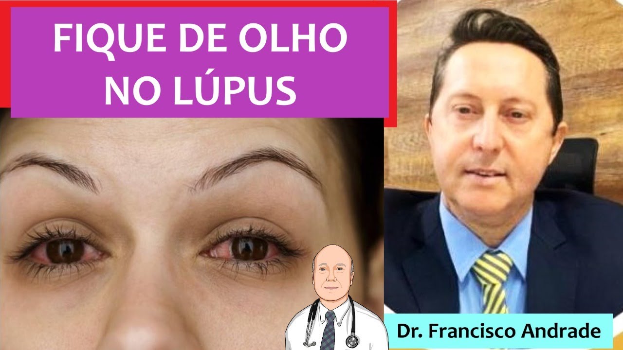 Problemas nos olhos de quem tem lúpus eritematoso sistêmico