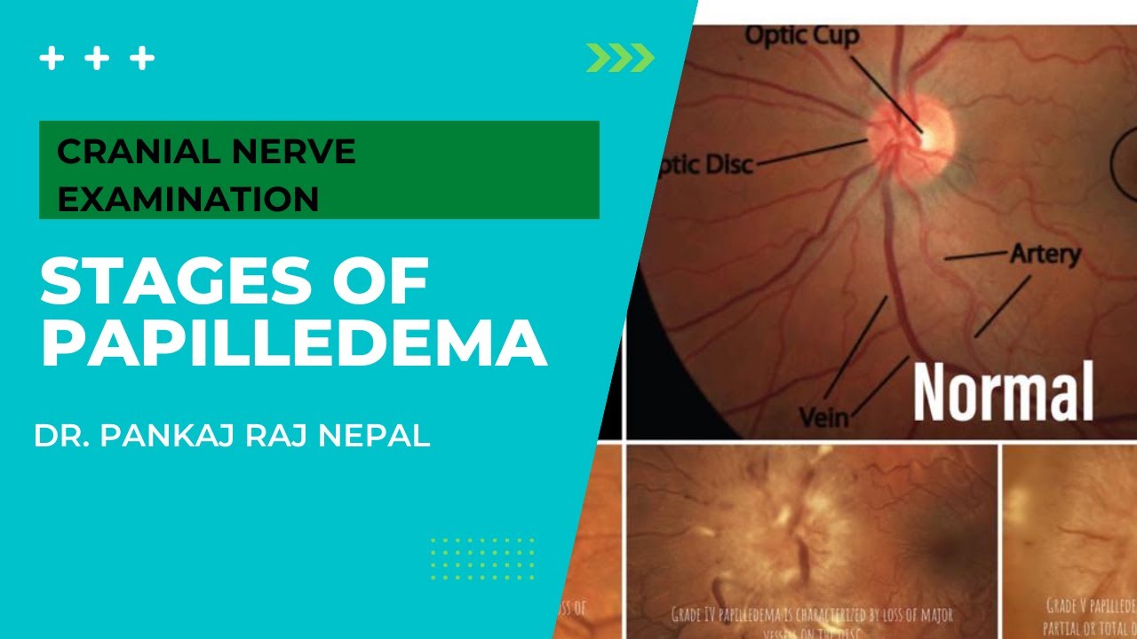 stages of papilledema, cranial nerves examination. Dr. Pankaj Raj Nepal. Aarya Neuro Hospital.