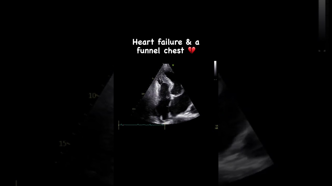 Heart failure & a funnel chest 💖