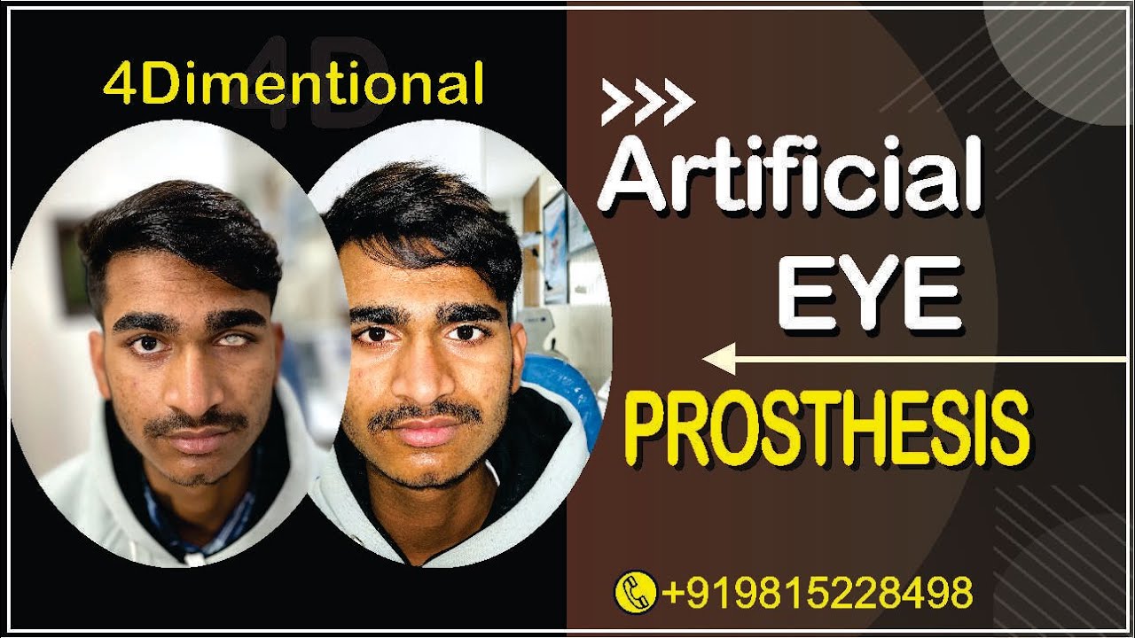 ARTIFICIAL EYE I PROSTHESIS  I