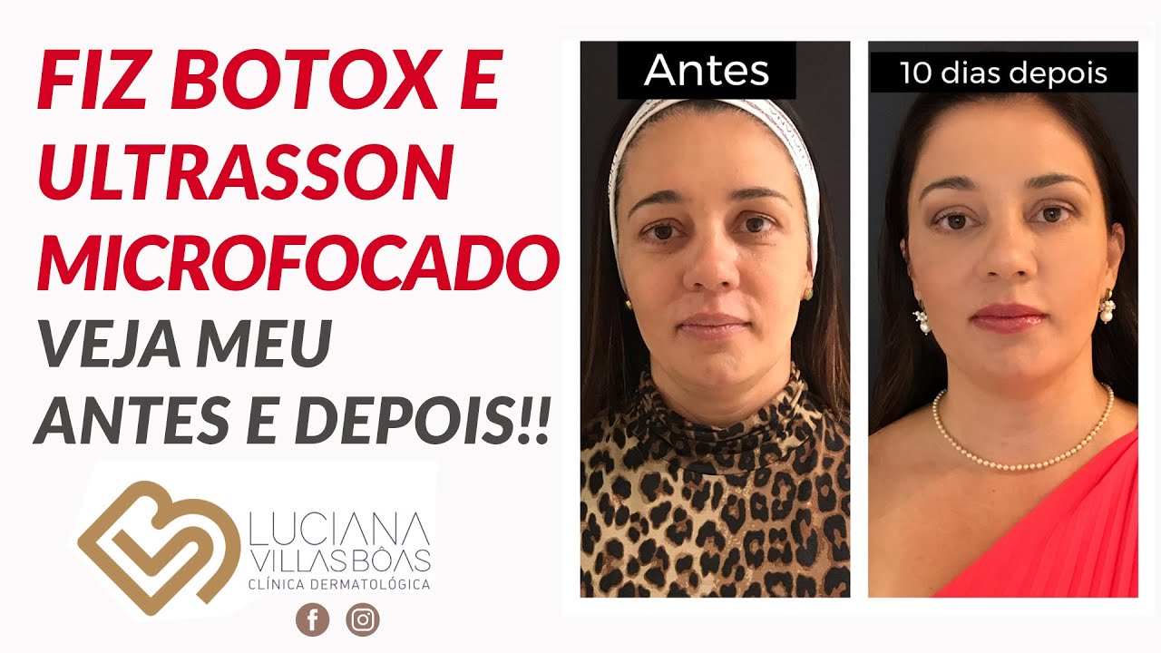 Meu antes e depois do Botox e Ultrasson microfocado  - Levantando as sobrancelhas!