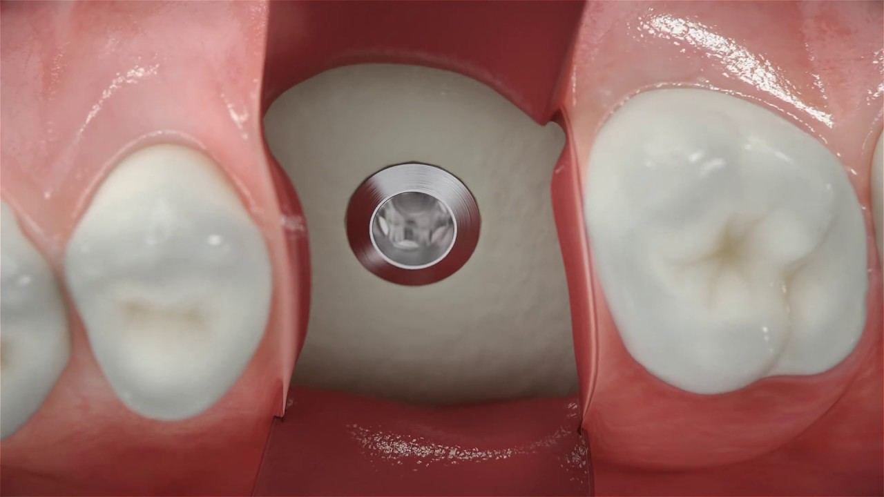 Straumann® BLX - Conventional posterior implant placement
