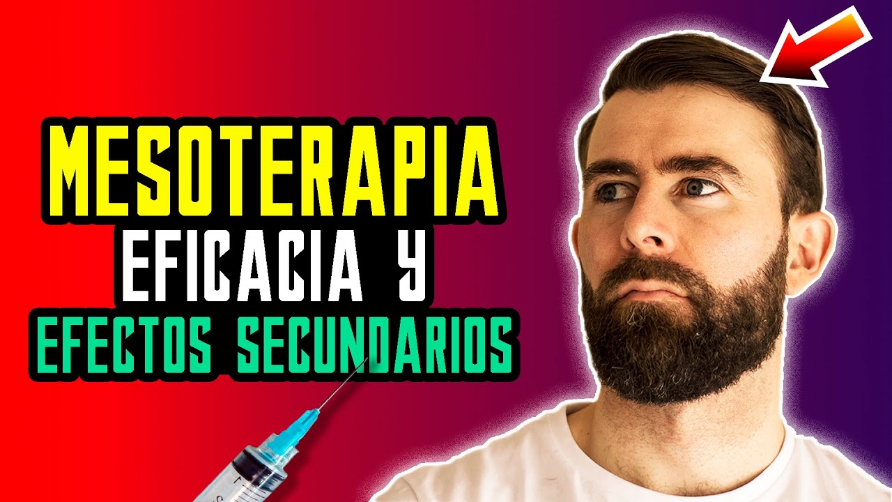 Mesoterapia Con Dutasteride Para Recuperar El Pelo