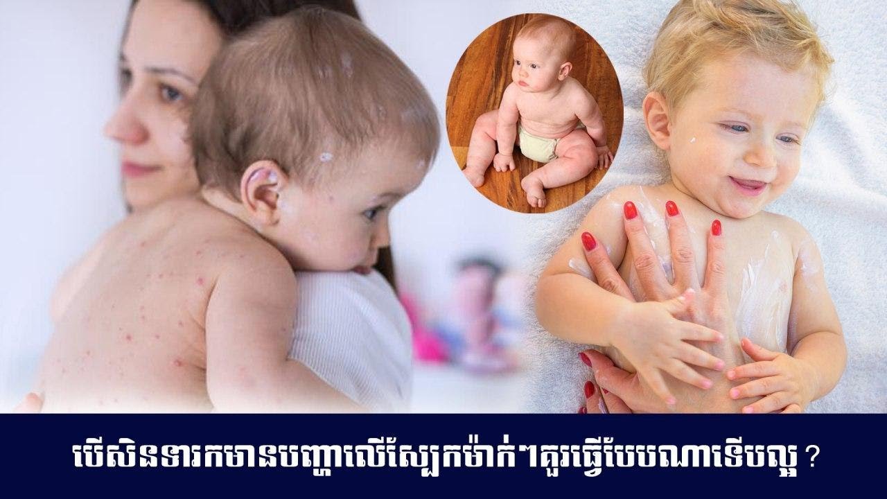 សុខភាពកូនតូច៖ បើសិនកូនតូចៗ មានបញ្ហាលើស្បែក តើម៉ាក់ៗគួរធ្វើបែបណាទើបល្អ?