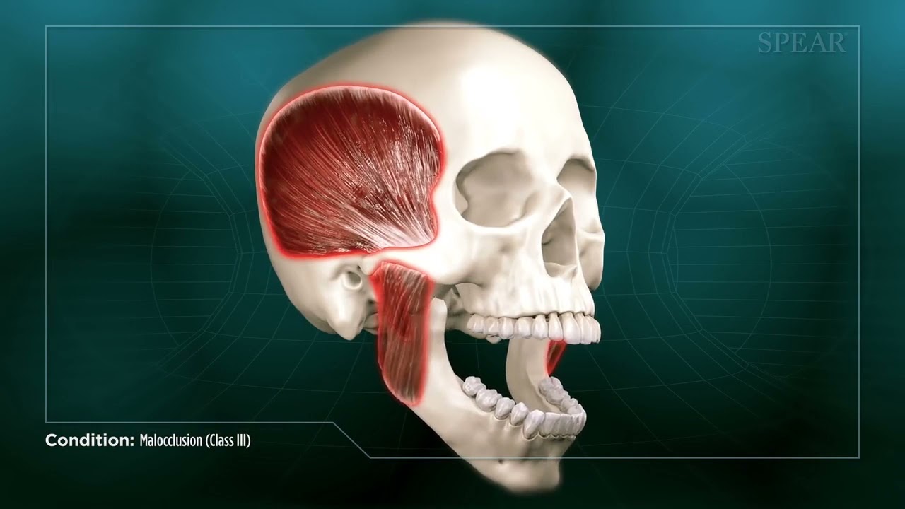 Malocclusion (Class III)