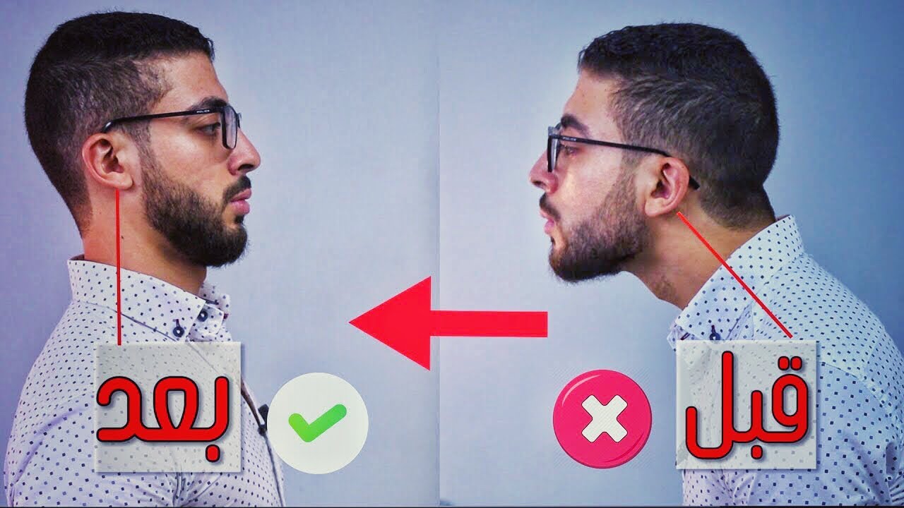 بروز الرأس للامام وتحدب الرقبة - forward head posture