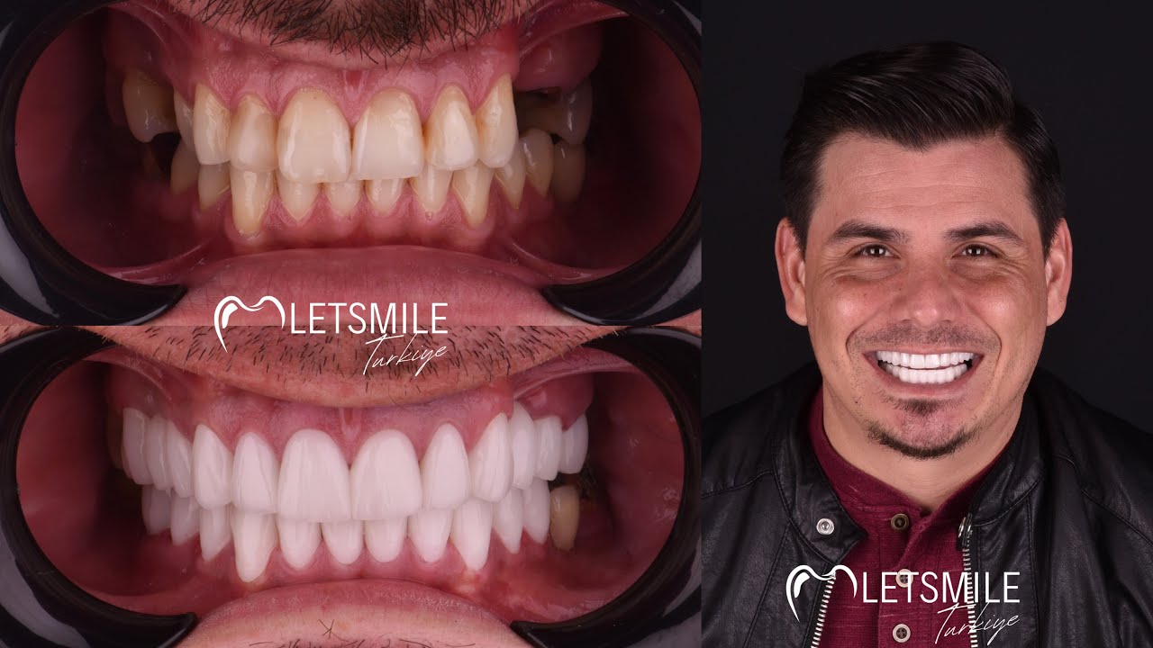 LETSMILE TURKIYE | ANTALYA DENTAL TREATMENT | ANTALYA BEST CLINIC | BEST PRICES | TURKEY DENTAL CARE