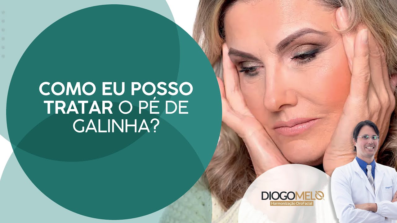 Como tratar a Região de Pé de Galinha (Orbicular dos Olhos) - Toxina Botulínica