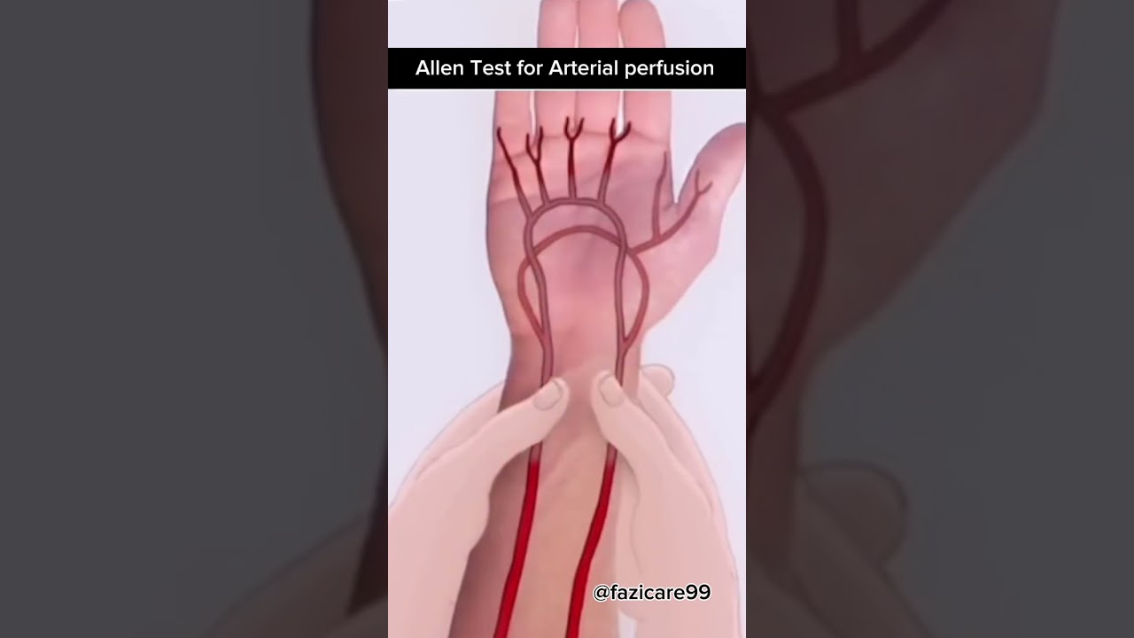 Allen Test for Arterial perfusion | how it works:😯