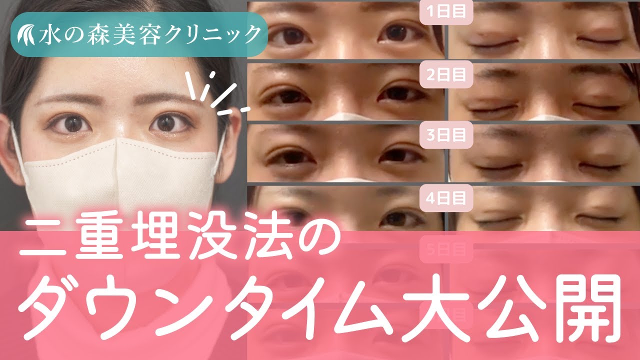 【経過】痛みは？どのくらい腫れる？二重埋没法のダウンタイムを大公開！【水の森美容クリニック】