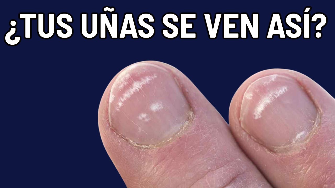 TUS UÑAS TE AVISAN QUE ESTÁS ENFERMO - 12 datos de enfermedad sistémica (onicólisis, astilla, etc)