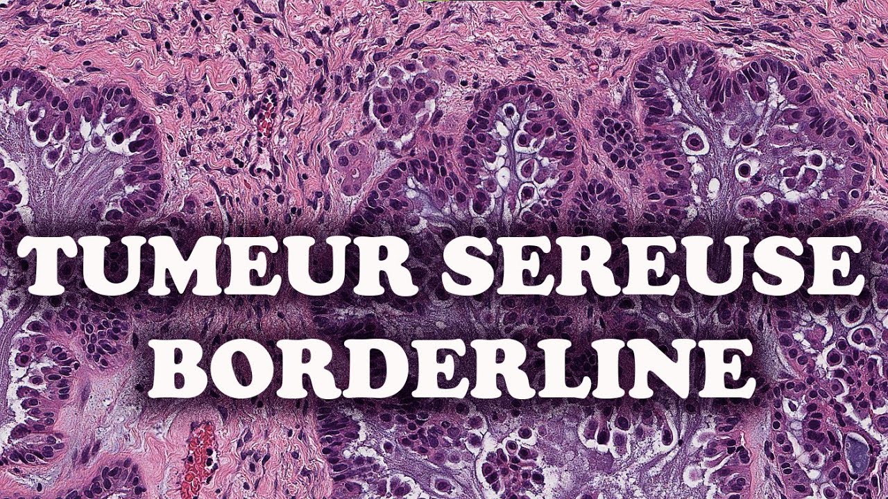 LA TUMEUR SEREUSE BORDERLINE DE L&rsquo;OVAIRE (Partie 3) - PATHOLOGIE