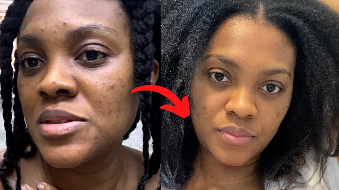 Postpartum skincare routine that WORKS | Postpartum Acne