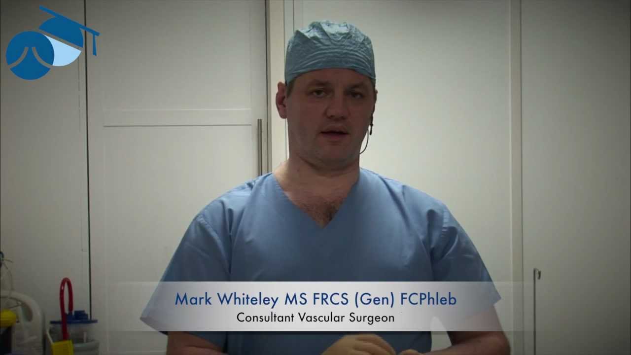 Explanation of foam sclerotherapy for varicose veins