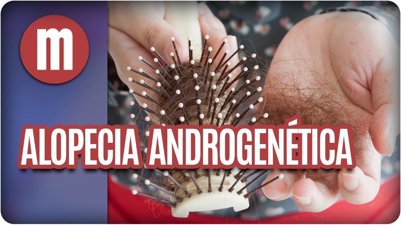 Alopecia Androgenética: Calvície Feminina  - Mulheres (08/11/17)
