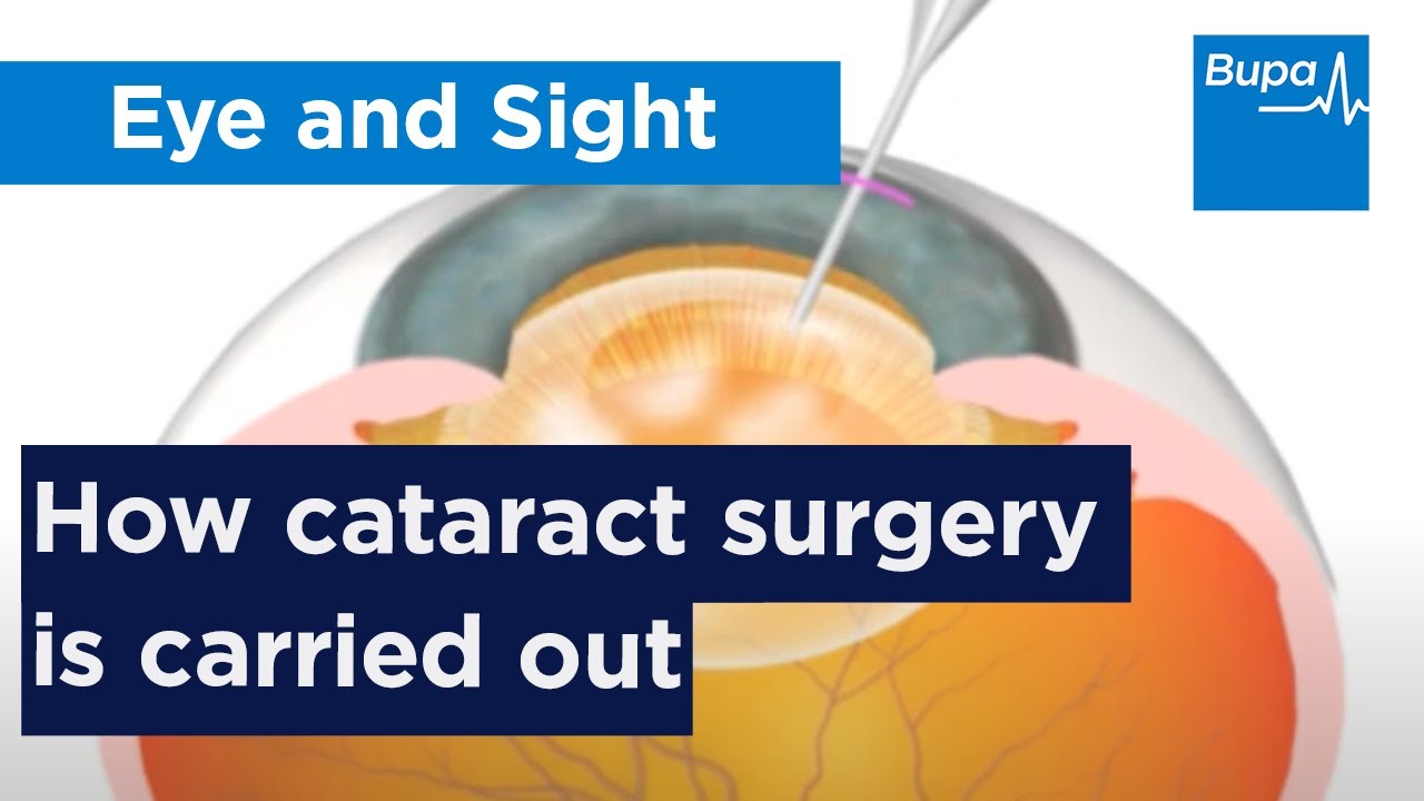 How cataract surgery is carried out | Bupa Health