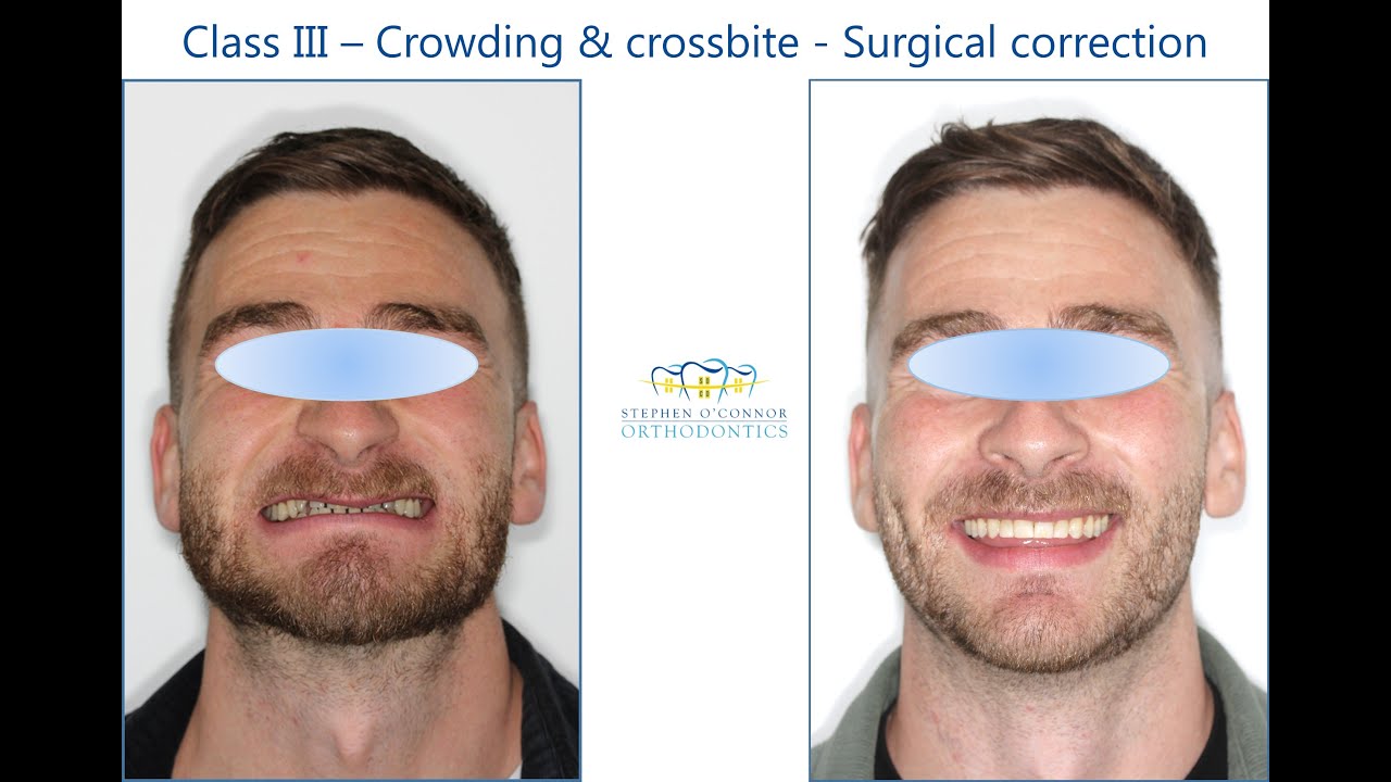 Class III occlusion & vertical maxillary deficiency (&lsquo;Short upper jaw&rsquo;) - Orthognathic surgery