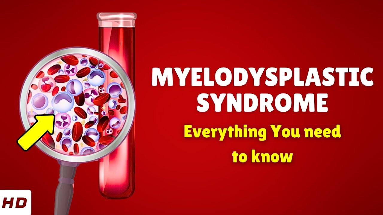 Myelodysplastic Syndrome – Causes, Types, Signs and Symptoms, Diagnosis & Treatment