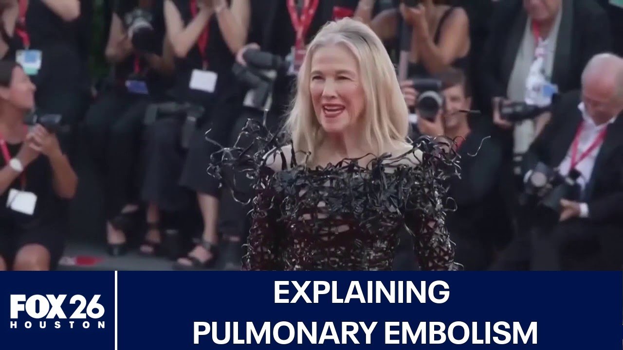 Explaining pulmonary embolism: Catherine O'Hara's cause of death