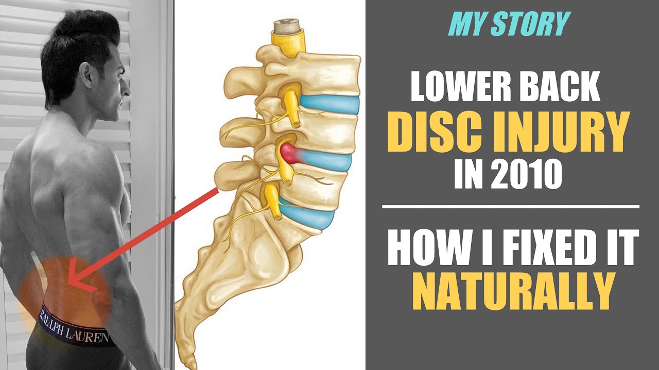 My Lower Back Disc Injury in 2010 - How I Fixed it NATURALLY (Guru Mann)