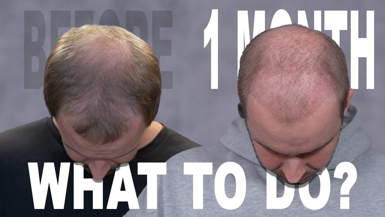 1 MONTH | HAIR TRANSPLANT | COSMEDICA CLINIC