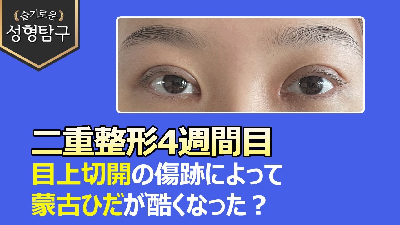 目の整形4週間目、目上切開の傷跡と蒙古ひだが気になる！