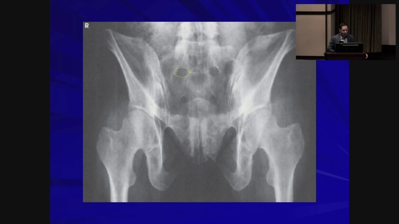 Pelvic and Acetabular Fractures - Anthony Spinnickie, MD