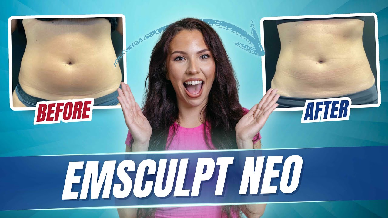 EmSculpt Neo Before & After | Real Results, Fat Loss & Muscle Gain (ThinWorks Palm Beach Gardens)