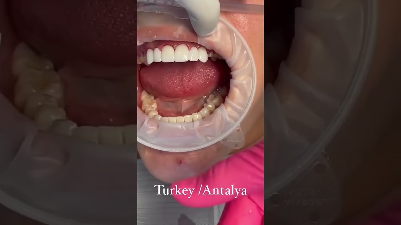 Zirconium Crowns Transformation at Dentatur in Turkey 