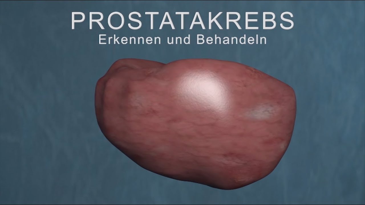 Prostatakrebs – Erkennen und Behandeln