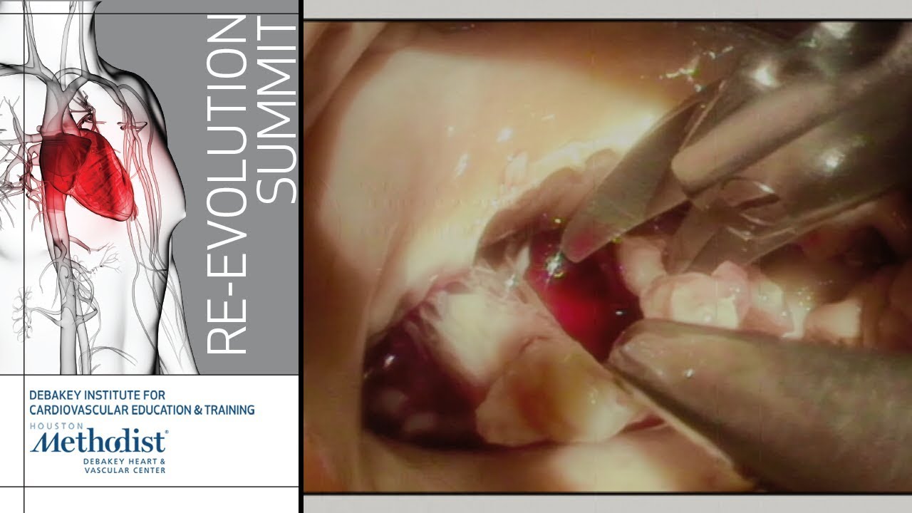 Minithoracotomy Approach to Tricuspid Valve (Marc Sakwa, MD)