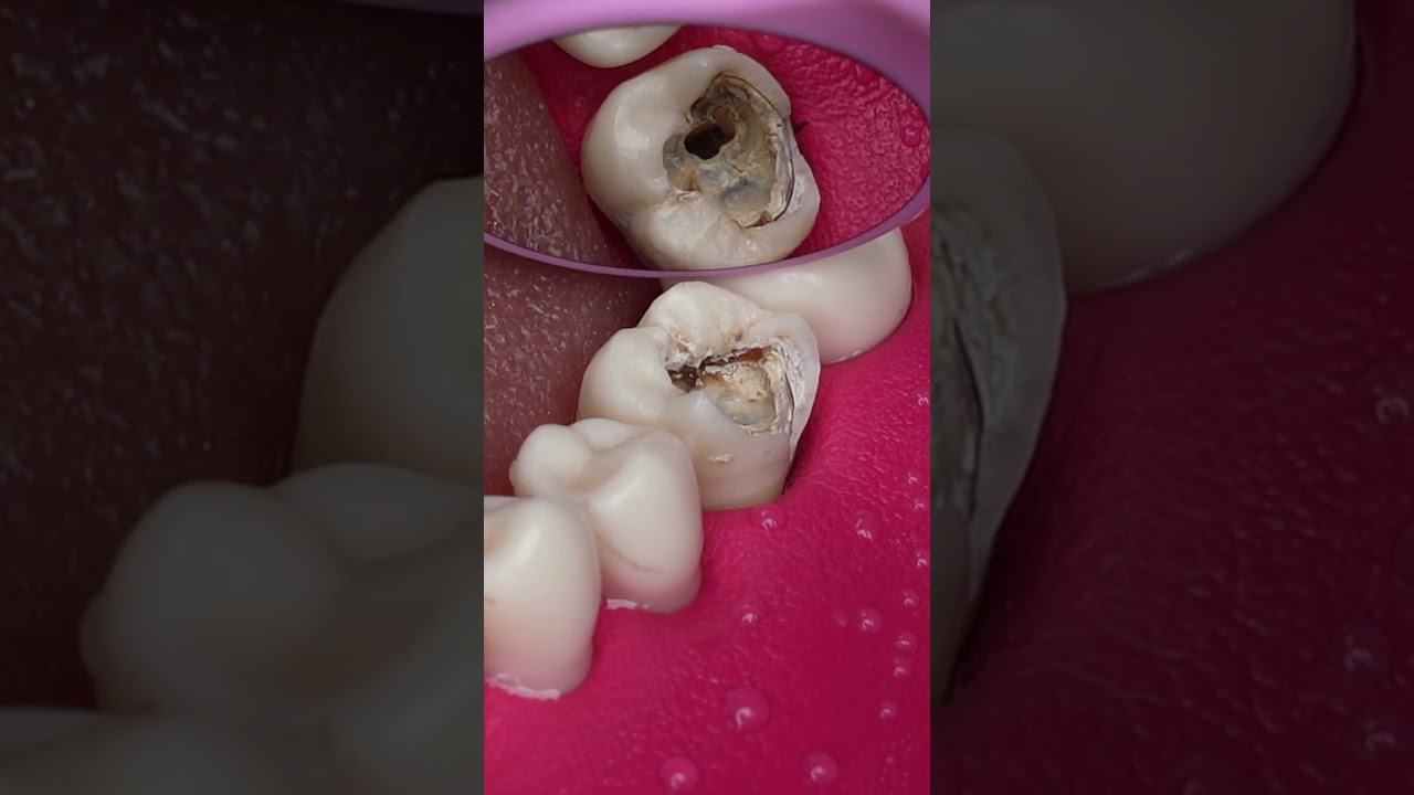 Dentist Looking Tooth Cavity #dentist #satisfying