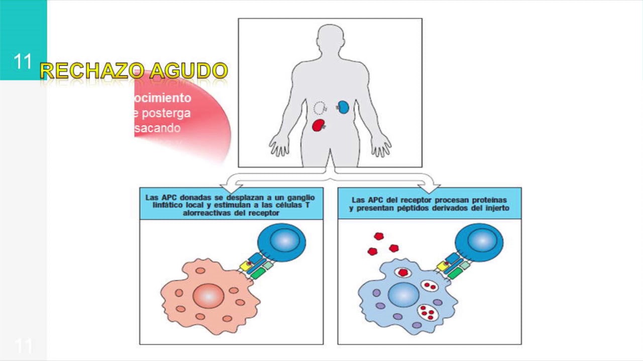Noviembre 2019 - Complicaciones post trasplante renal.