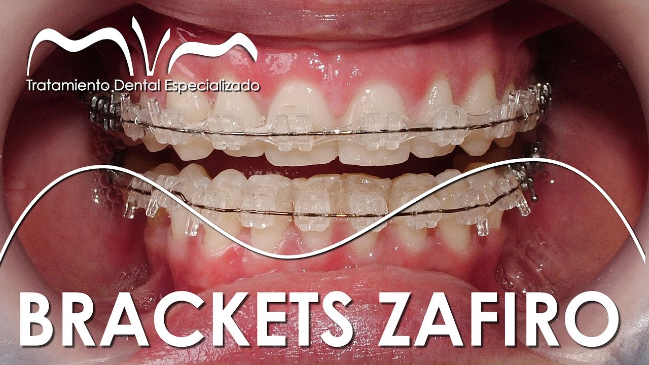 TODO SOBRE LOS BRACKETS ZAFIRO | ¿YA TE DECIDISTE?