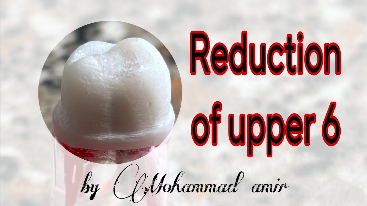 Reduction of upper 6 (endo bolck)✨♥️