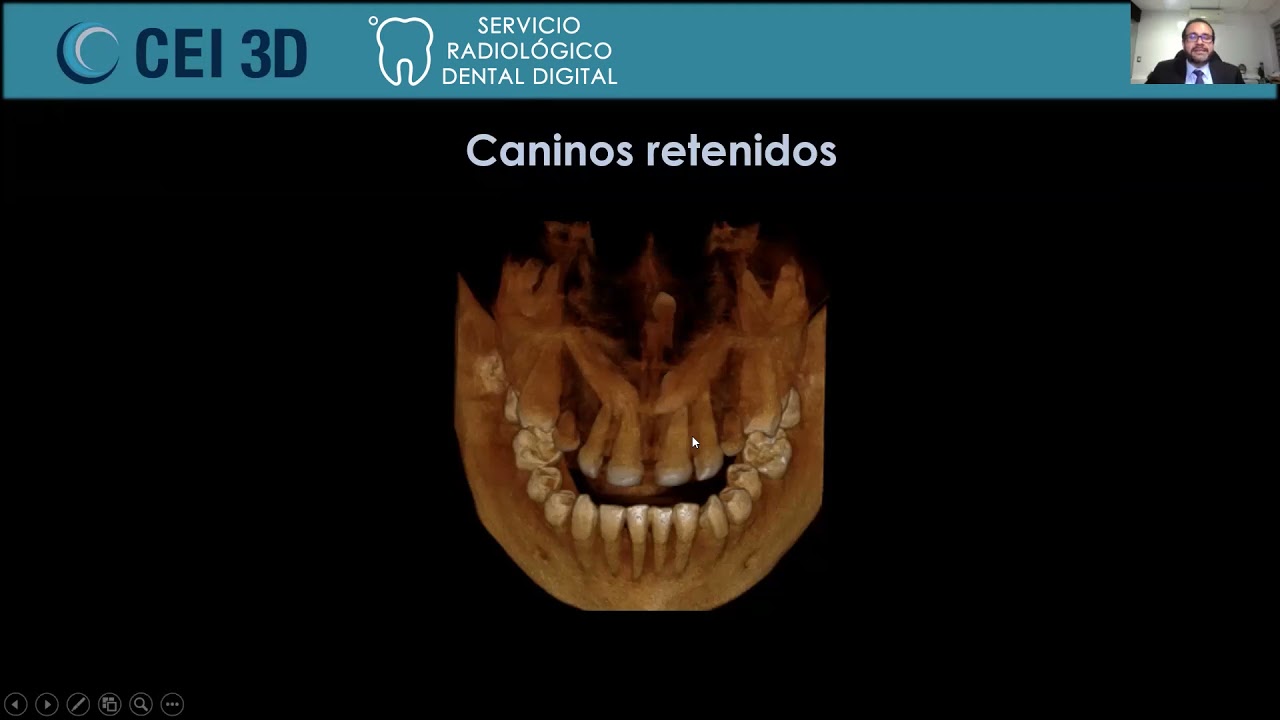 La mejor herramienta para el diagnostico de dientes retenidos