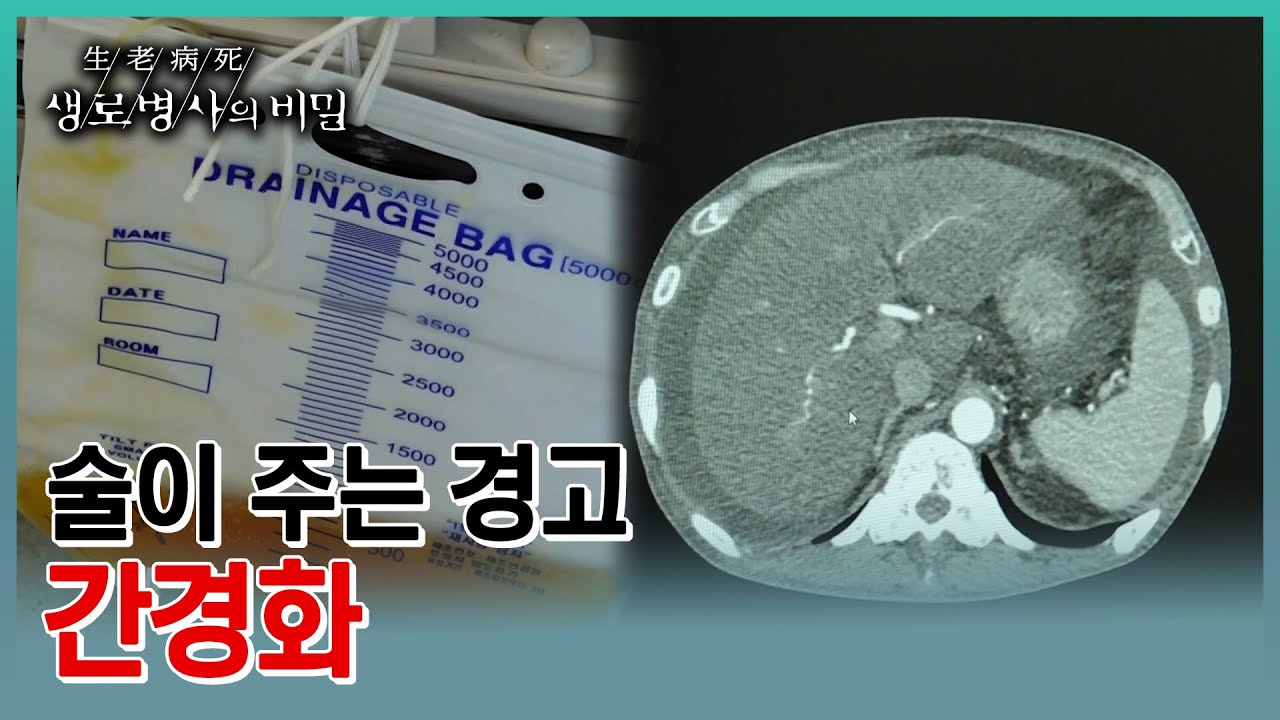 당신이 모르는 사이 딱딱해진 간. 아주 사소하다고 생각할 수 있는 원인이 있다면?? (KBS 20230405 방송)