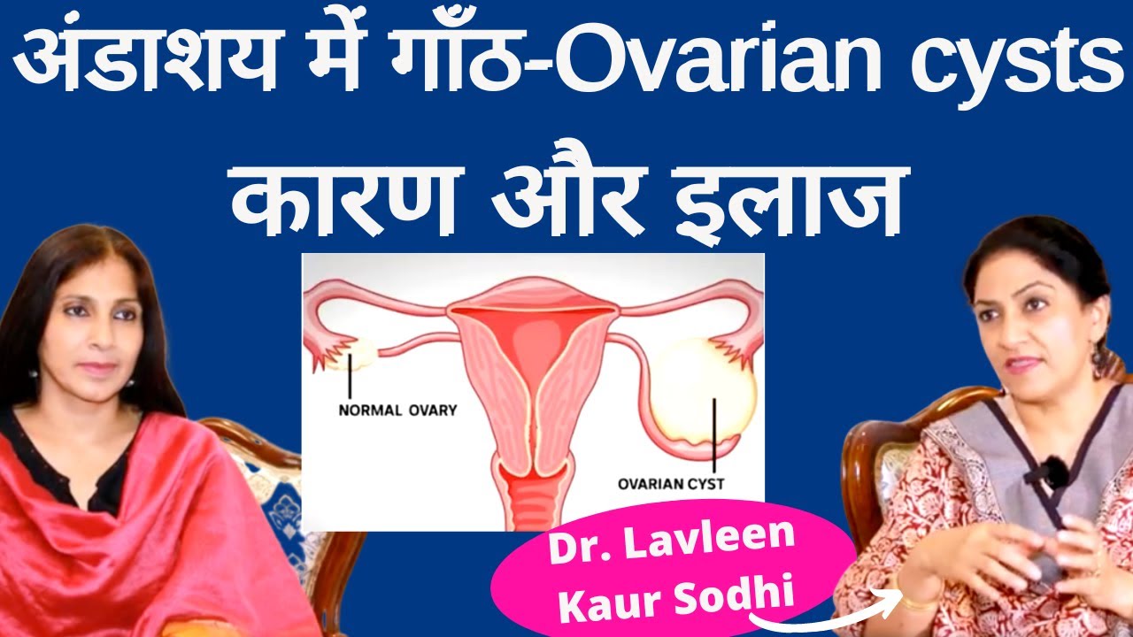 Ovarian Cysts। ओवरी में सिस्ट क्यों हो जाती हैं, क्या है इलाज। Dr Lavleen Sodhi