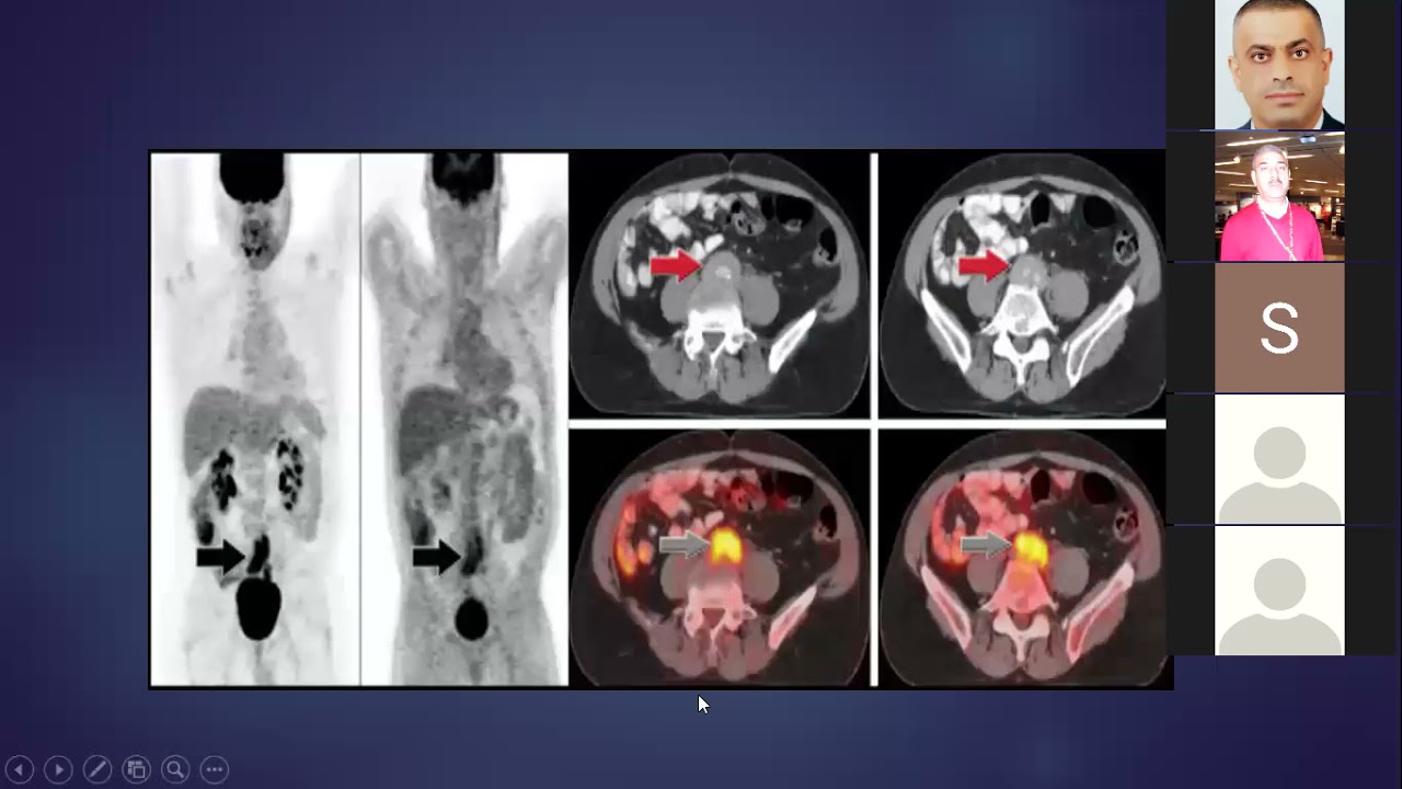 retroperitoneal fibrosis