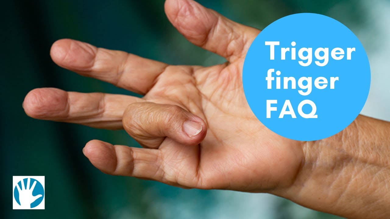 Trigger Finger FAQ - Midland Hand Clinic