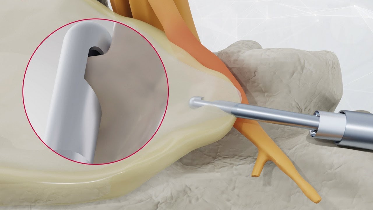 GUILLOTINE - News in endoscopic disc decompression!