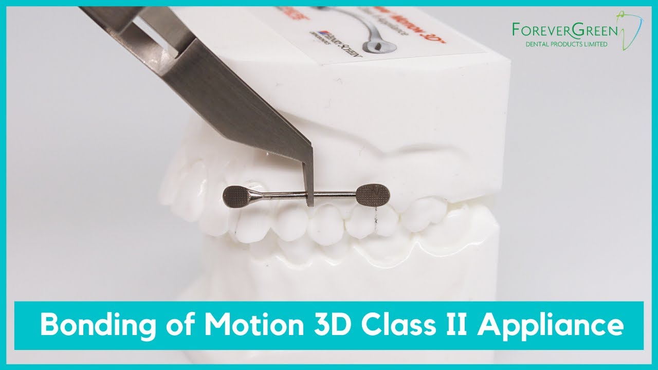 Forever Green | Bonding of Carriere® Motion 3D™ Class II Appliance